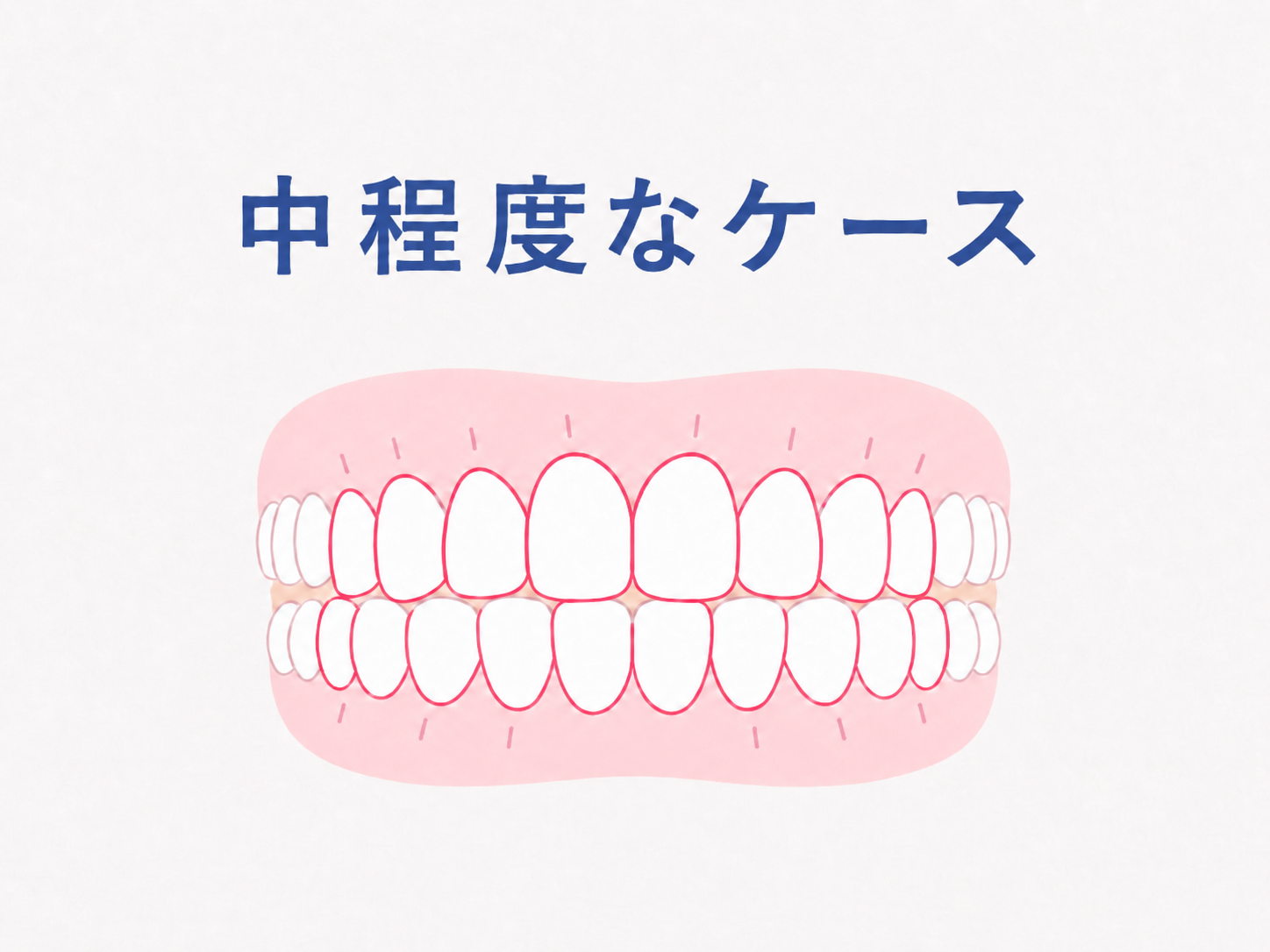 ノーマル